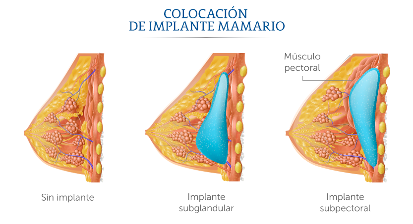 Ilustración de colocación de implante mamario.