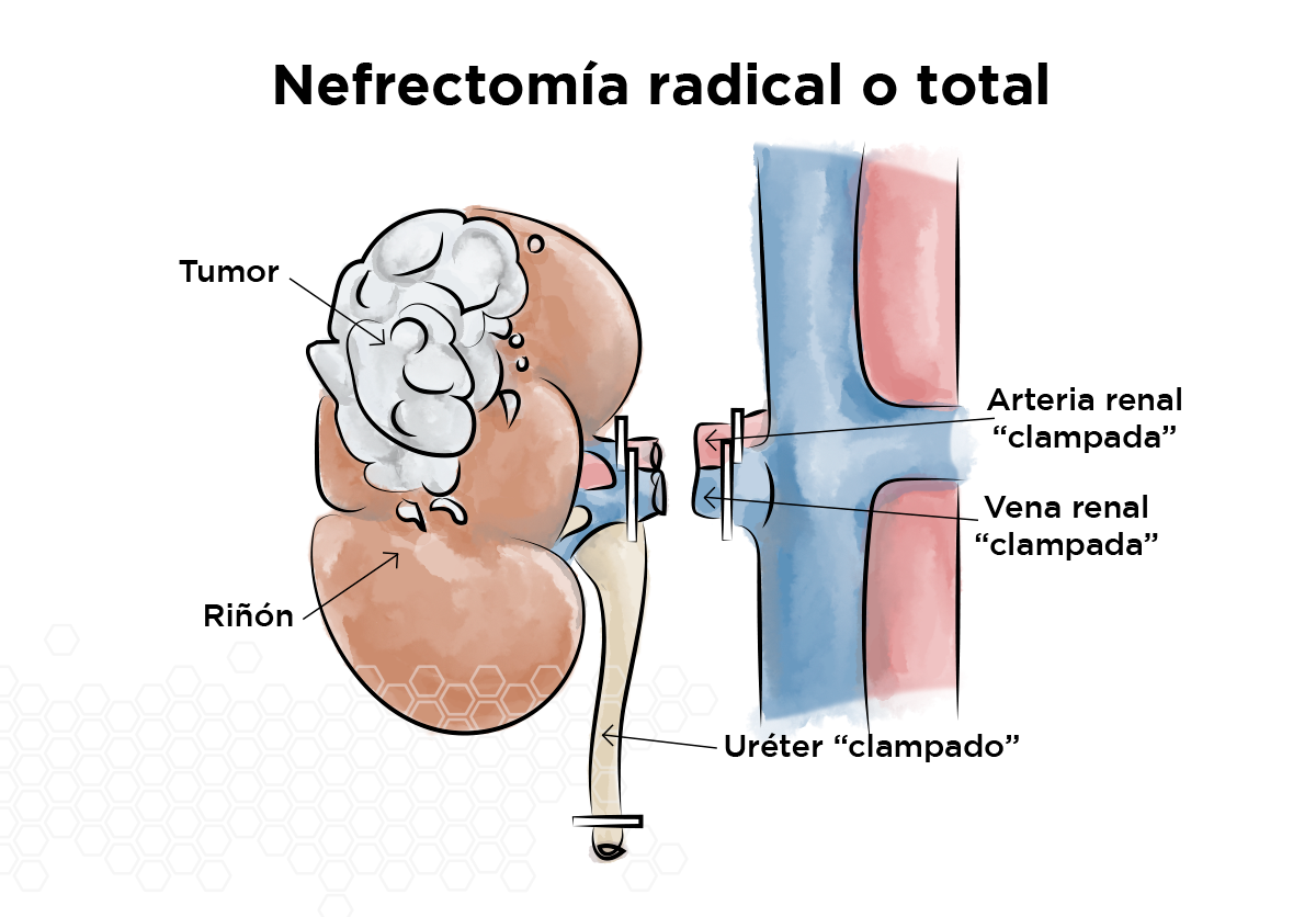 Nefrectoma radical o total