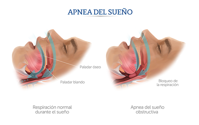 Ilustración de apnea de sueño y respiración normal.