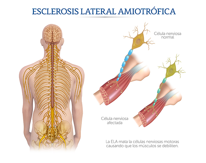 Ilustración de la Esclerosis Lateral Atrófica