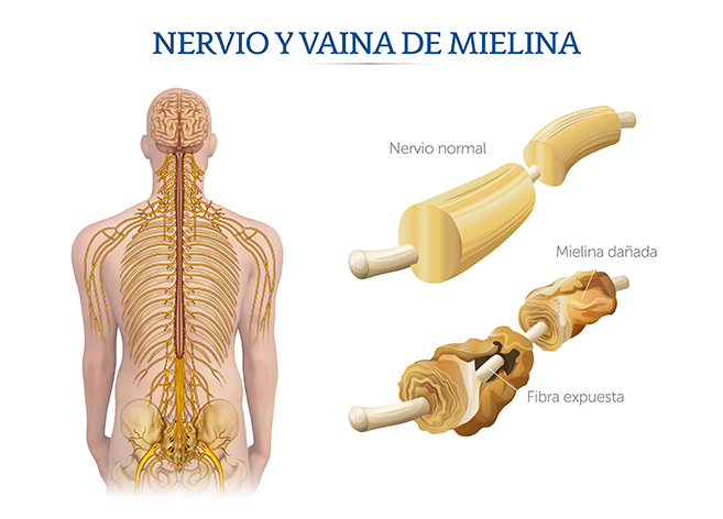 Ilustración el efecto del síndrome Guillen-Baré en los nervios